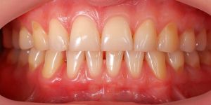 Receding gums treatment
