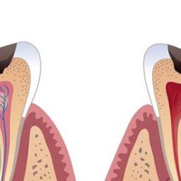 The Different Types of Tooth Decay and How to Treat Them