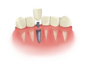 Tooth Injuries and Pain