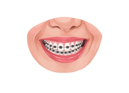 Teeth Alignment