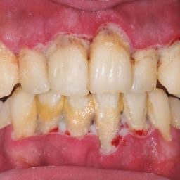 Why do patients get calculus deposits on teeth despite regular brushing