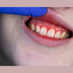 Why Do My Gums Bleed? Understanding the Causes and Solutions for Gum Disease